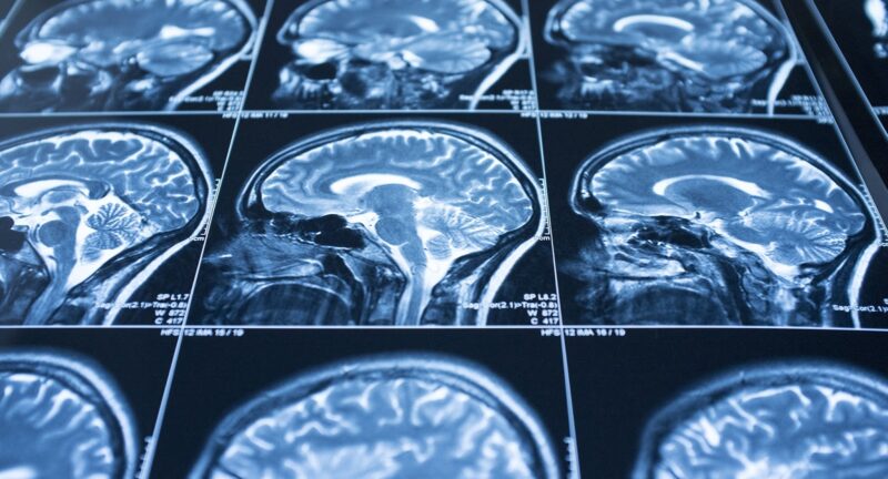 Cómo funciona la Hipnosis Clínica: Desentrañando los Secretos